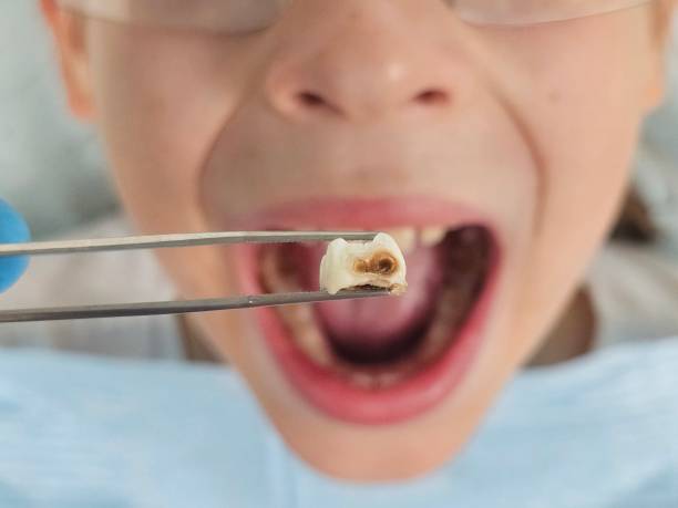 Best Broken or Cracked Tooth Emergency Dentist in Cheswick, PA